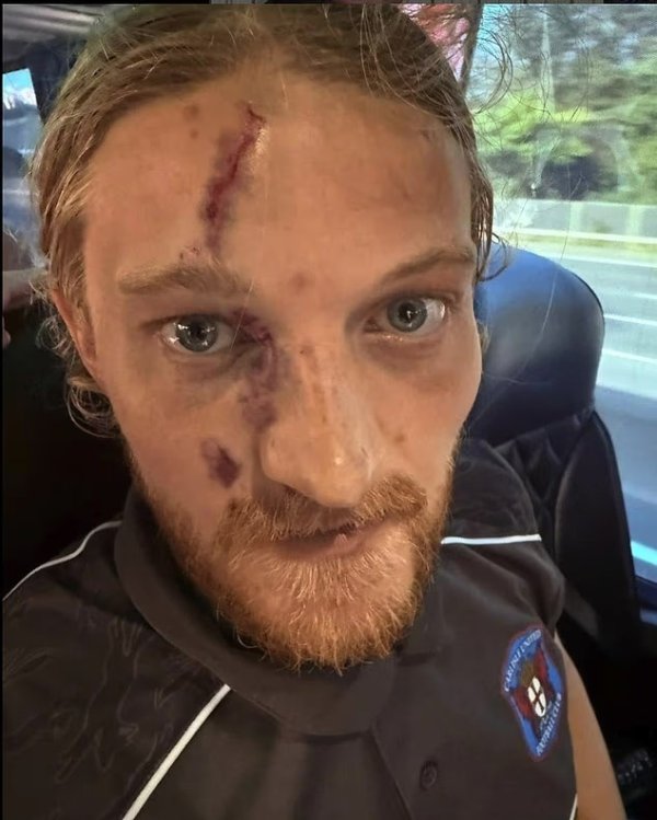 太拼了!英格兰第五级别职业联赛 前场球员与守门员拼抢,面部被严重划伤 太拼了!英格兰第五级别职业联赛 前场球员与守门员拼抢,面部被严重划伤